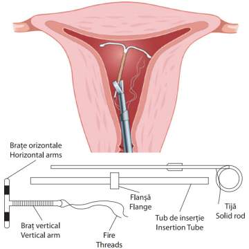 Sterilet intrauterin TCu380A, cu fir spiralat si colier din cupru, in forma T, 32mm, steril (1 bucata)